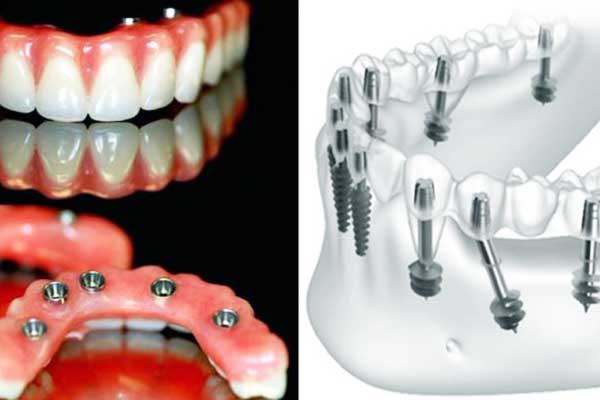 average cost of dental implants per tooth