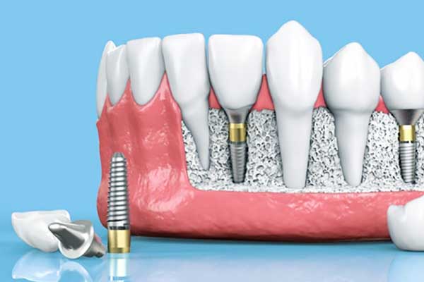 Discover the Truth About Aspen Dental Implants: The Ultimate Guide to Restoring Your Smile