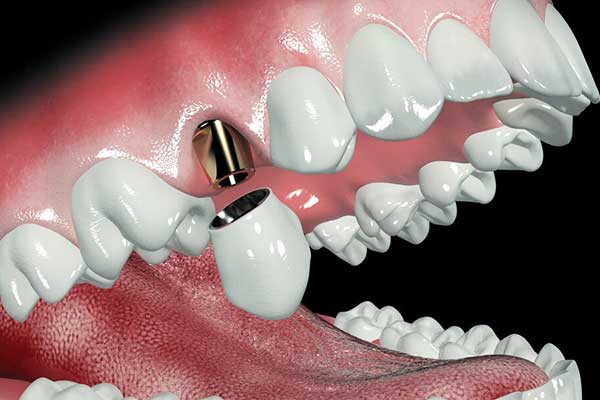 bad dental implants