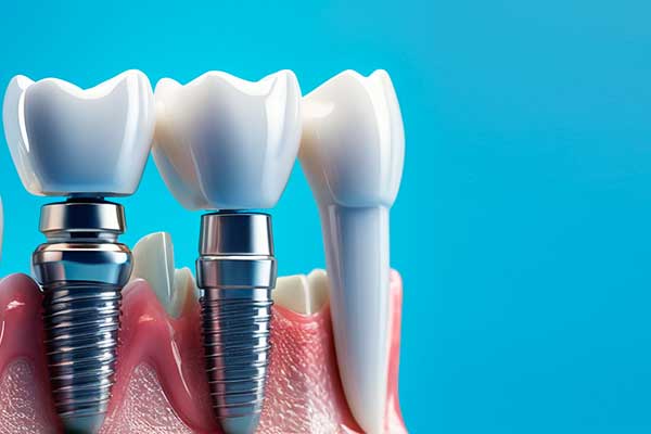 The Ultimate Guide to all on four dental implants : Everything You Need to Know