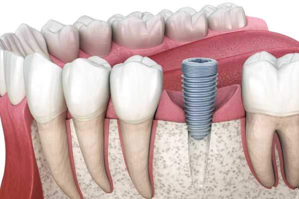 average price of dental implants