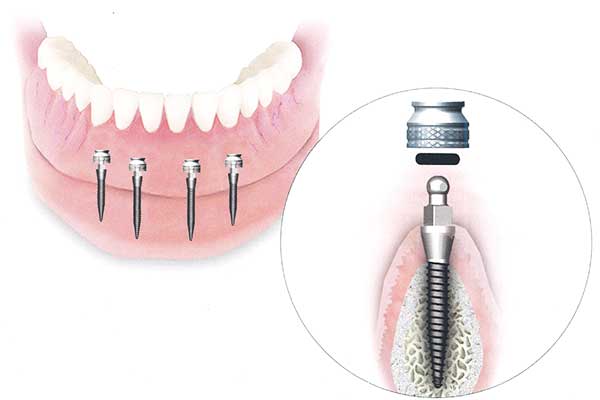 average cost of full mouth dental implants