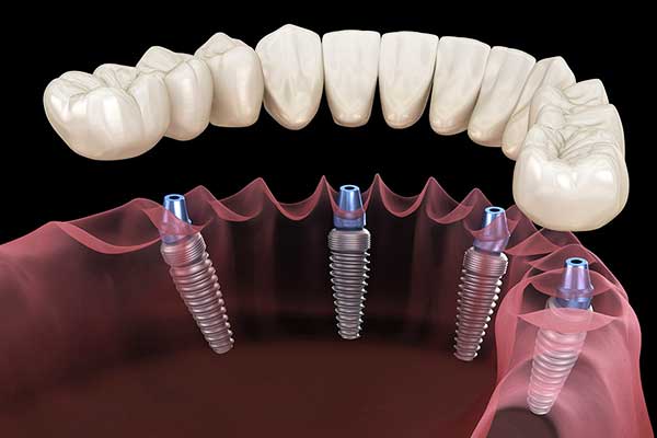 average cost of full dental implants