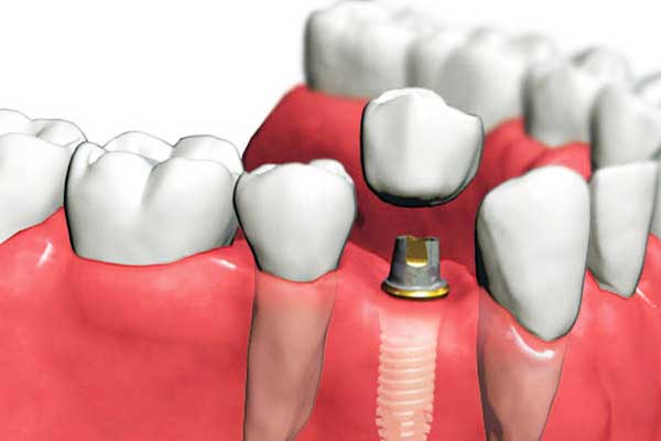 average cost of dental implants