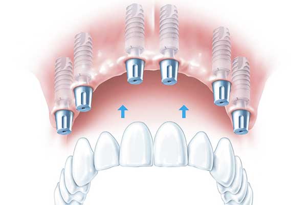 The Comprehensive Guide to all on six dental implants : Your Path to a Perfect Smile