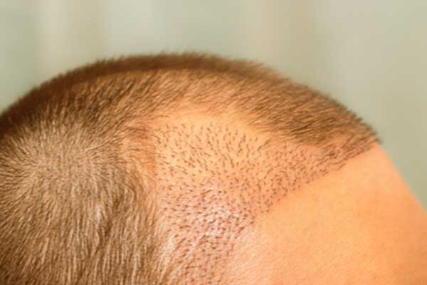 Hair Transplant in Turkey