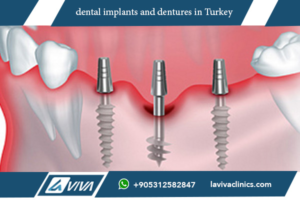 Cost of Full Mouth Dental Implants Turkey