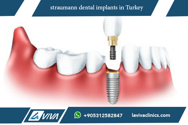 Dental Implants Finance Turkey