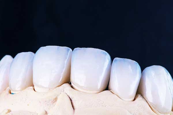 Tandimplantaten in Turkije