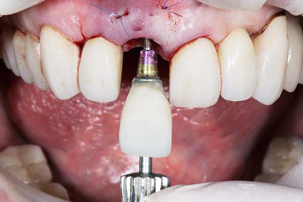 Beste Tandarts in Turkije