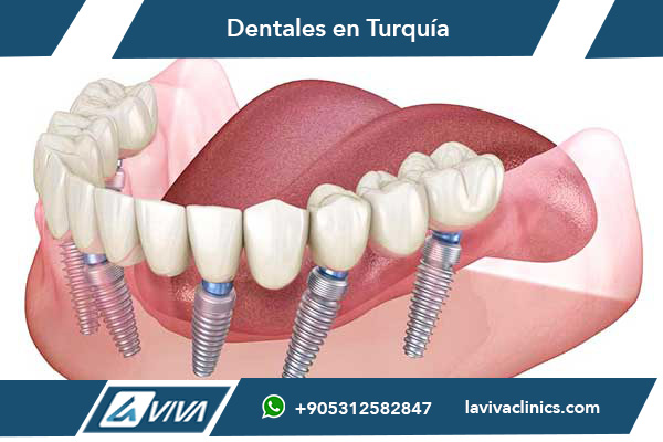 All-on-4 Dental Implants Istanbul Turkey 2025 - Complete Guide & Best Prices | Laviva Clinic