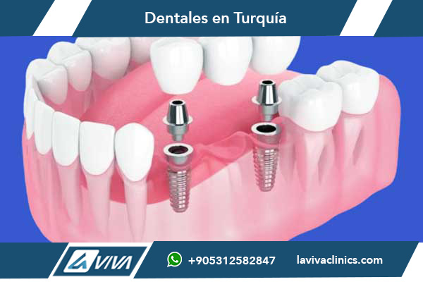 Best Dental Implants in Turkey