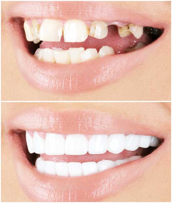 All-on-4 Dental Implants Istanbul Turkey 2025 - Complete Guide & Best Prices | Laviva Clinic