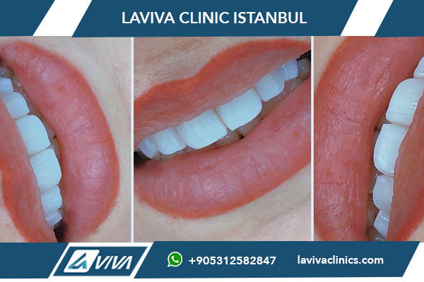 Úprava zubů v Turecku Newsmile