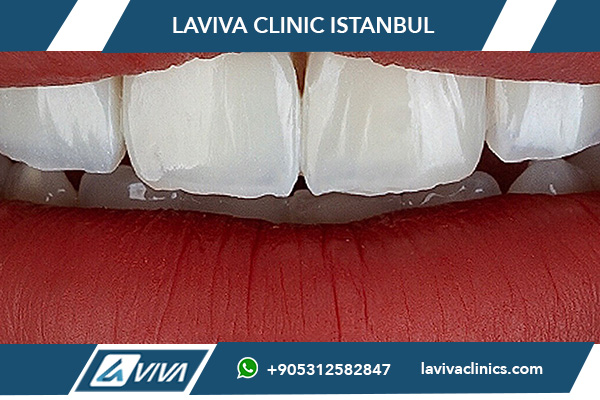 Kolik stojí zuby v Turecku