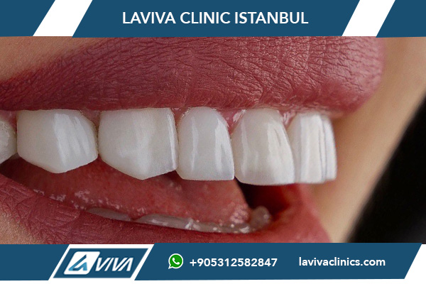 Zubní implantáty Turecko cena