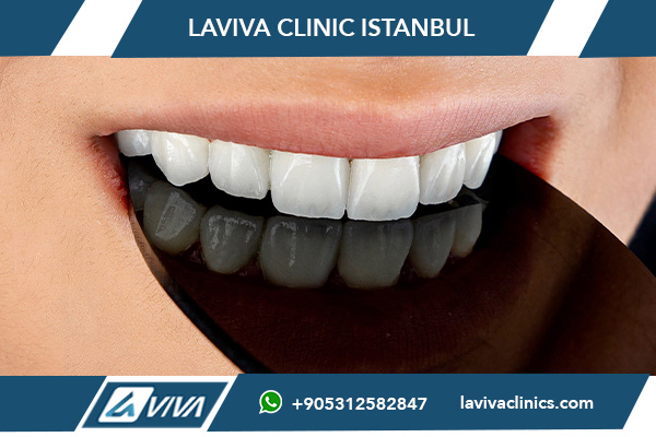 Nové zuby Turecko cena